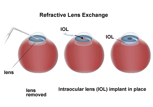 Diagram showing refractive lens exchange process